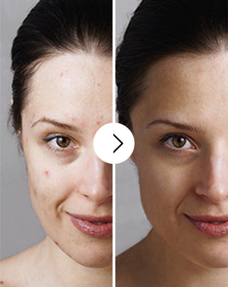Derminax tabletten met zink en vitamine C, E en B2 voor acne, puistjes en onvolkomenheden_3 - 3