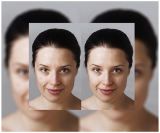 Comprimés Derminax avec zinc et vitamines C, E et B2 pour l&#39;acné, les boutons et les imperfections