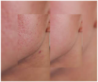 Comprimés Derminax avec zinc et vitamines C, E et B2 pour l&#39;acné, les boutons et les imperfections