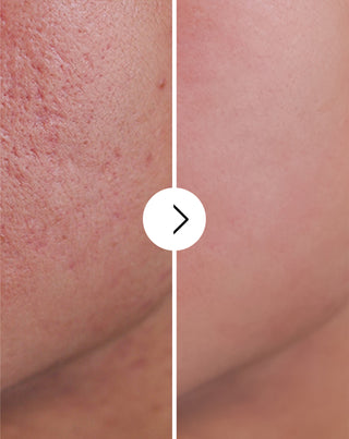 Derminax tabletten met zink en vitamine C, E en B2 voor acne, puistjes en onvolkomenheden_4 - 4