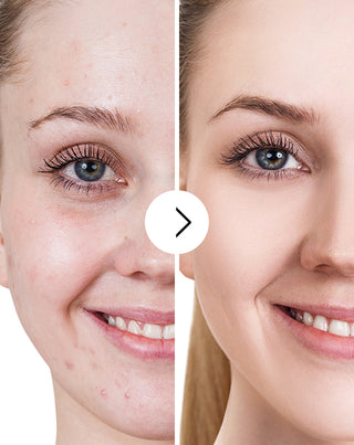 Derminax tabletten met zink en vitamine C, E en B2 voor acne, puistjes en onvolkomenheden_5 - 5