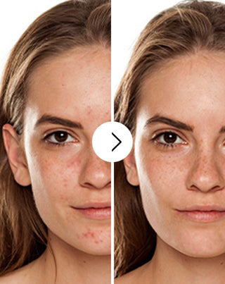 Derminax tabletten met zink en vitamine C, E en B2 voor acne, puistjes en onvolkomenheden_2 - 2